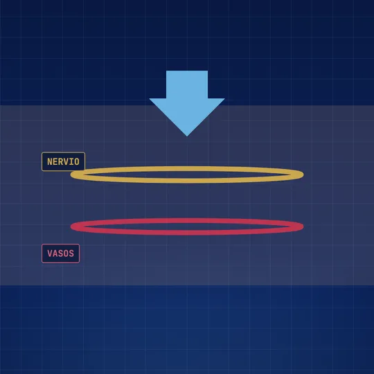 Corte de la pierna: una flecha presiona desde arriba y aplasta un nervio, en amarillo, y un vaso sanguíneo, en rojo.